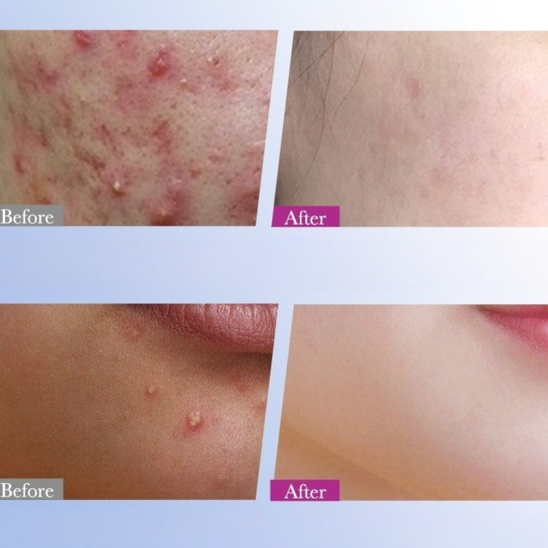 7/10/14Pcs Colorful Star Acne  - Skincare Qv ulasan dan harga